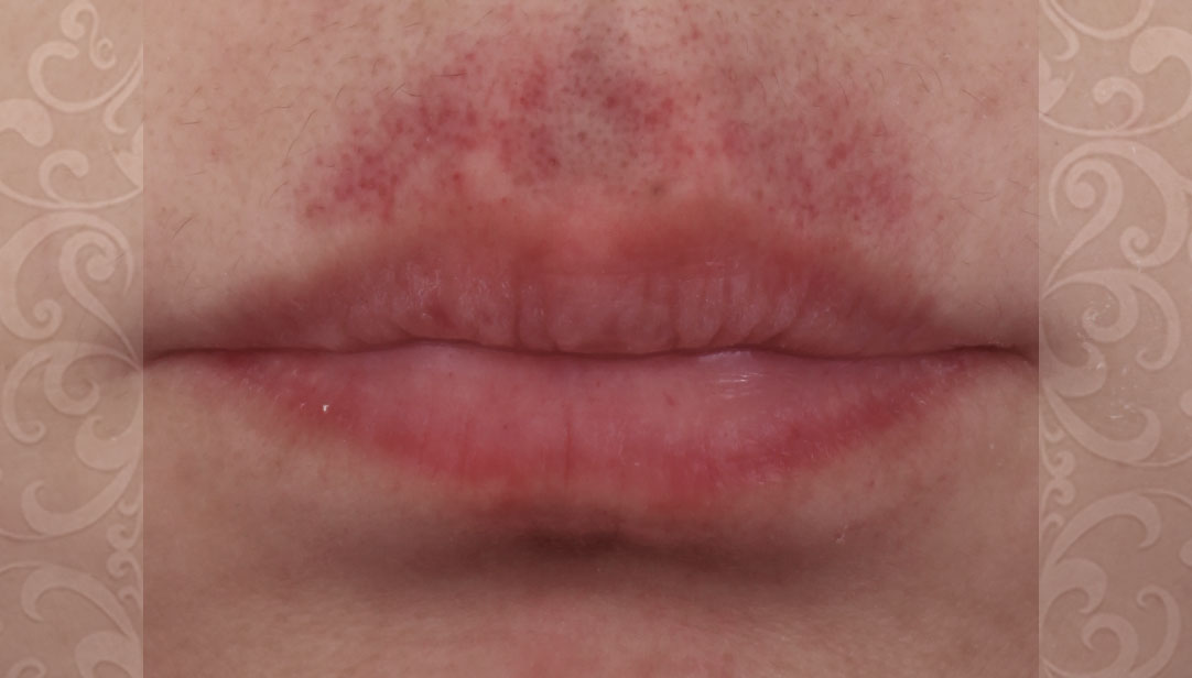 12 Hickey Hiding Tips That Work 12 Hickey Hiding Tips That Work