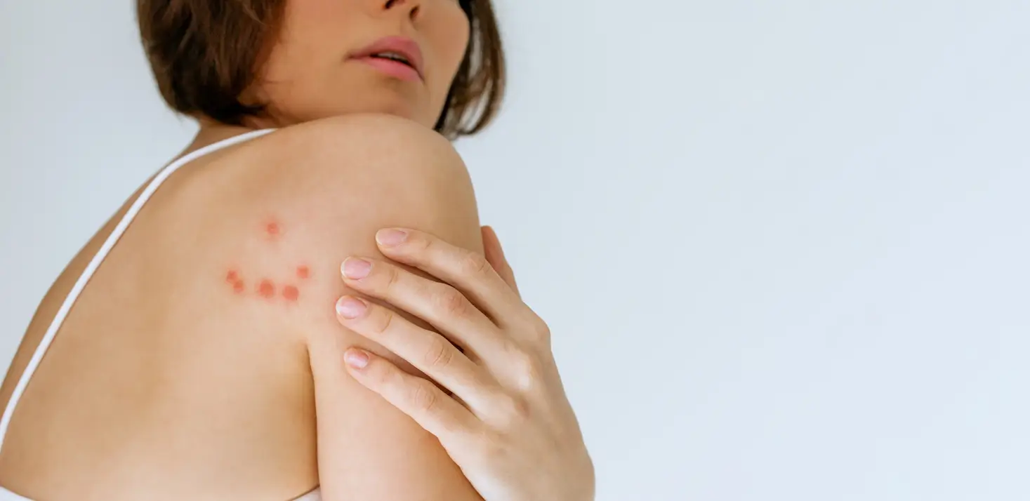 Bed Bugs Bite: Identify Common Target Areas