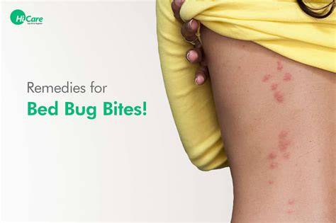 Bed Bugs: Where They Bite And How To Prevent Bed Bugs: Where They Bite And How To Prevent