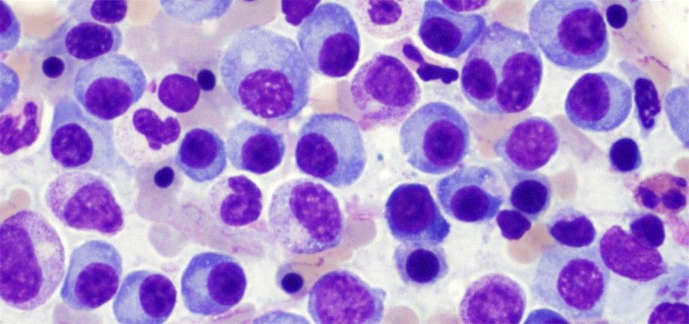 Myeloma Survival Rates: Latest Breakthroughs